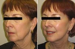 fat transfer to face, autologous fat transfer to face, facial fillers, juvaderm, restylane,