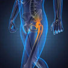 Hip Replacement: serious complications