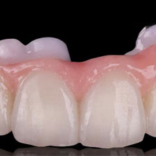 The PRETTAU® ZIRCONIA Dental Implant Bridge