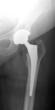 Dr. Khoury Addresses Growing Incidents of Joint Replacement Surgeries