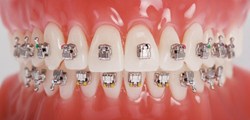 Utah valley braces