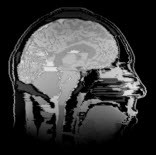 XFdtd EM Simulation Software Approximate MR Image