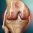 Two Key Changes in New Clinical Guidelines for Treating Knee...
