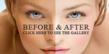 Non-Surgical Procedures are Now Available at a Discount at Strax...