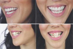 Before and After Photos