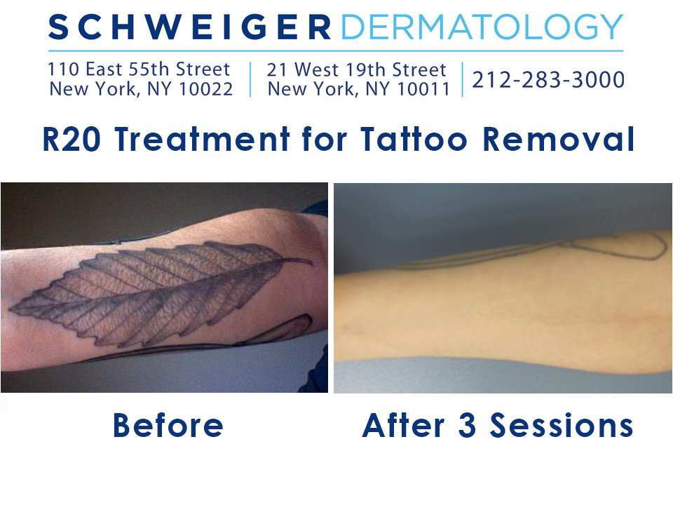 ... tattoo removal procedure from a Schweiger Dermatology patient in New
