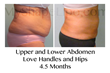 MyShape Lipo Saves One Woman's Life with Large Volume Liposuction