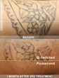 PicoSure® Tattoo Removal Laser Is Now Available in Philadelphia...