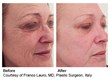 Lutronic® Announces FDA Clearance for INFINI™, an Ideal Solution...