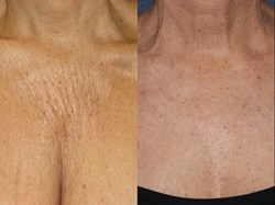 Sculptra San Diego