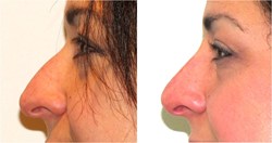 Before and After non-surgical rhinoplasty