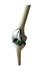 Verasense Knee System