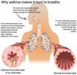 Exercising with Asthma: Tips to Remember