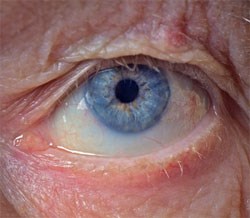elderly person blinded by pharmcist