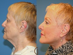 Orange County Facelift