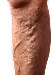 The New York Vein Treatment Center is launching a new health campaign designed to educate the public about the complications of advanced stage venous disease.