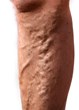 Chicago Vein Care Center Releases a New Article to Inform the Public...