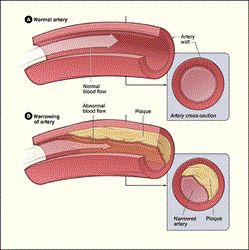 The Siragusa Vein and Vascular Center in Nashville, TN has published a new article on their website describing the causes of arterial disease and peripheral arterial disease