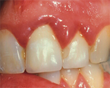 Link Between Oral Health and Heart Disease Leaves Nothing to Smile...