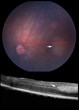 Early In Vivo Visualization of Retinoblastoma Tumors in Histologic...