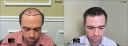 Hair Restoration Specialists