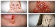 how to treat herpes get rid of herpes help