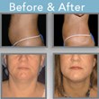 Lipo Body Sculpture of Houston Announces Breakthrough Treatment for...