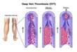 Siragusa Vein and Vascular Center Publishes New Article about DVT and...