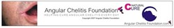 how to treat angular cheilitis how the angular cheilitis foundation