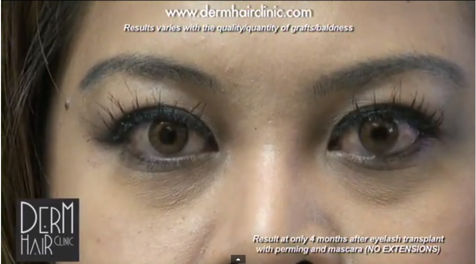 Patient of Dr. Umar Reveals Her FUE Eyelash Transplant Results in New Video