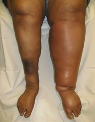 The New York Vein Treatment Center is launching a new social media campaign to educate the public on DVT risk factors