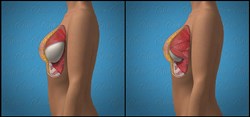 Orange County Breast Augmentation Surgeon