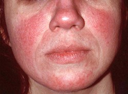 facial redness from rosacea