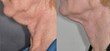 The Best Non Surgical Skin Tightening of the Eyelid , Face & Neck...