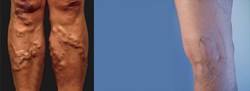 Advanced Vein Care Solutions Launches New Campaign to Educate on Seeking Vein Treatment