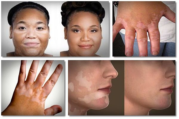 A New Article Releases 14 Home Remedies For Vitiligo V Kool 7498