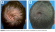 Male PRP patient - 8 months before-and-after