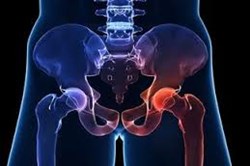 Hip Replacement: serious complications