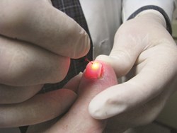 Toenail fungus laser treatment