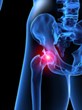 The Onder Law Firm Clarifies What the DePuy Hip Recall Lawsuit...