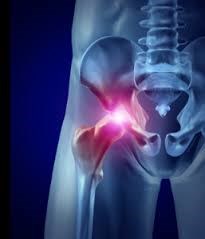 Wright Profemur Hip Replacement: serious complications