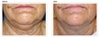 MyShape Lipo: First in Las Vegas to Offer The Venus Legacy Treating...