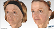 Dr. Steven Weiner Discusses the New FDA Approved Dermal Filler,...