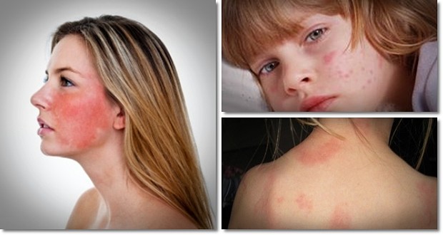 9 Tips On How To Get Rid Of Hives Fast At Home Healthreviewcenter