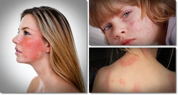 9-tips-on-how-to-get-rid-of-hives-fast-at-home-healthreviewcenter