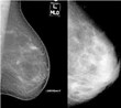 Montclair New Jersey Breast Center Supports “Are You Dense?” Day to...