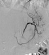 RSNA: Embolization Procedure Aids in Weight Loss