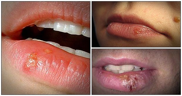 Tips for cold sores