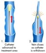 Advanced Vein Care Solutions Publishes New Article on Taking Advantage...