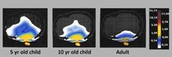 Children are at a greater risk of cell phone radiation because their skulls are thinner